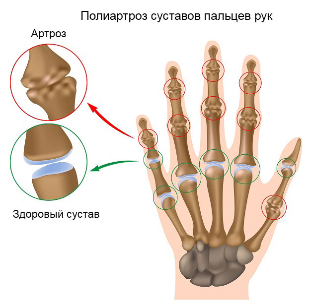 полиартроз суставов пальцев рук