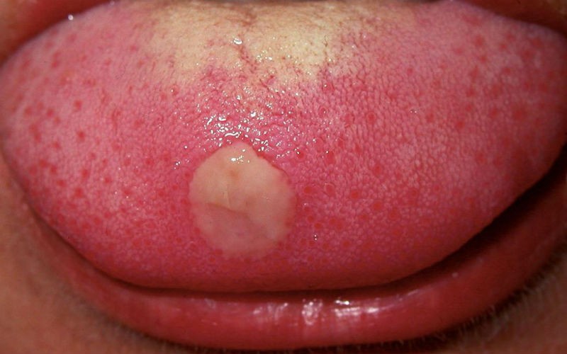 Бугорки на губах. Причины и лечение