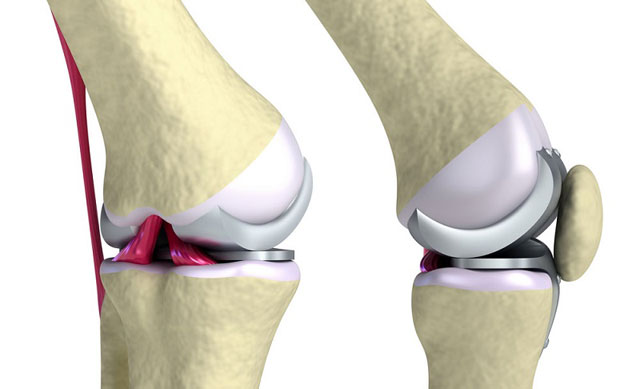 эндопротез коленного сустава