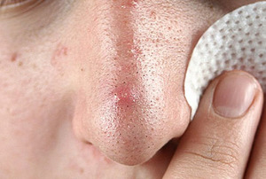 Комедоны: причины появления на лице и лечение кожи