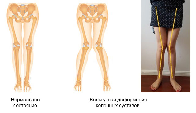 сравнение нормальных коленных суставов и с вальгусной деформацией