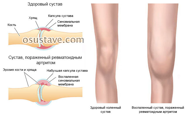 поражение коленного сустава ревматоидным артритом