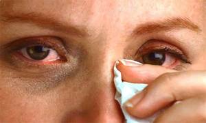 Аллергия на веках глаз, что делать
