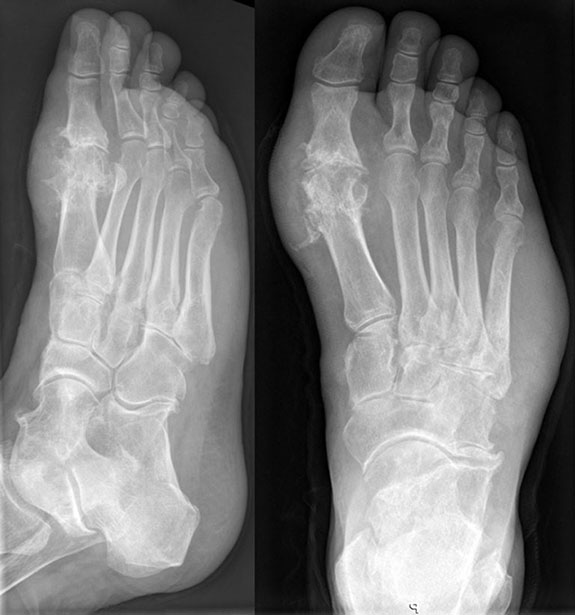 рентгеновский снимок стопы при подагрическом артрите