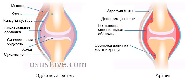 поражение сустава артритом на примере колена