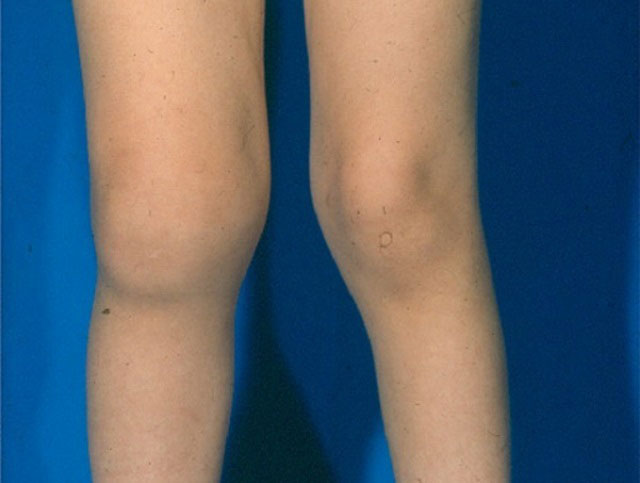 реактивный артрит, отек правого коленного сустава