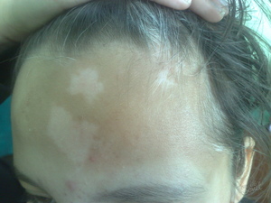 Белые пятна на коже у ребёнка: лечение пигментации кожи