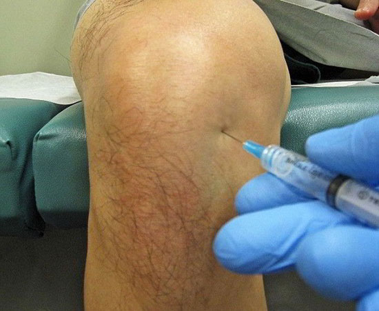 введение противовоспалительных средств в коленный сустав