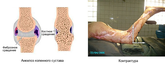 анкилоз и контрактура коленного сустава