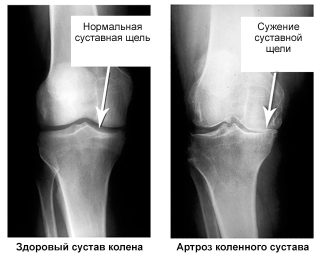 суставная щель здорового коленного сустава и пораженного артрозом на рентгене