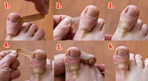 Что делать если впился ноготь на пальце