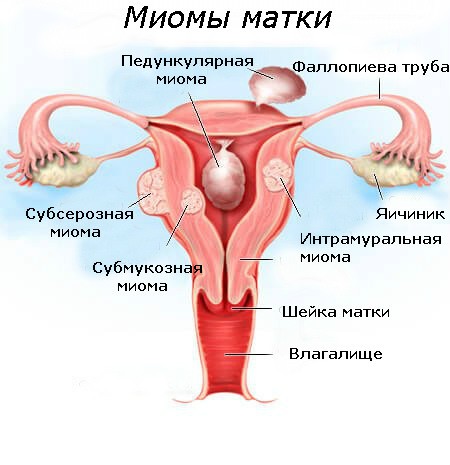 Признаки миомы матки. Миома матки пальпаторно.