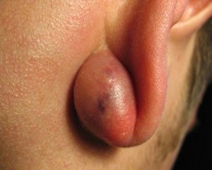 Шарик в мочке уха: симптомы