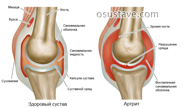 изменения в суставе при артрите (поражение коленного сустава)