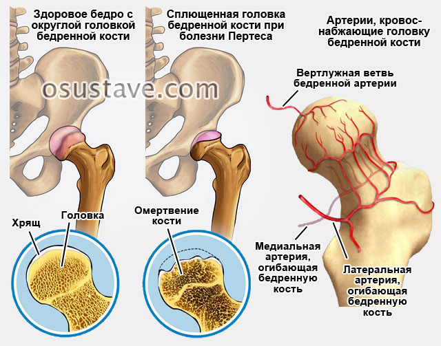 Операция тазобедренного сустава 1 степени. Болезнь Пертеса тазобедренного сустава. Болезнь Пертеса тазобедренного сустава у детей. Стадии болезни Пертеса головки бедренной кости. Остеохондропатия головки бедренной кости (болезнь Пертеса).