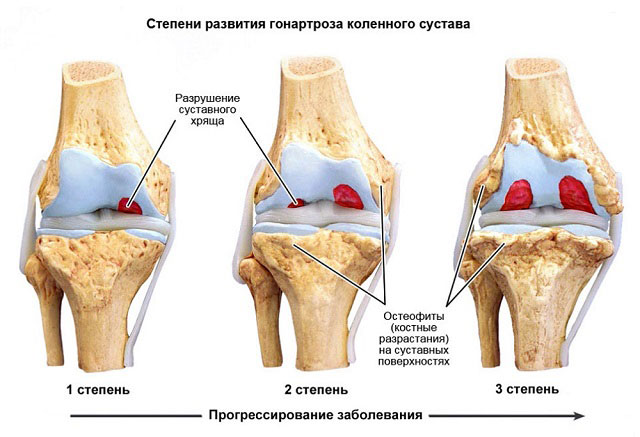 степени развития гонартроза коленного сустава