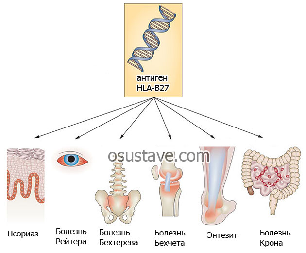 болезни, связанные с мутацией антигена HLA-B27
