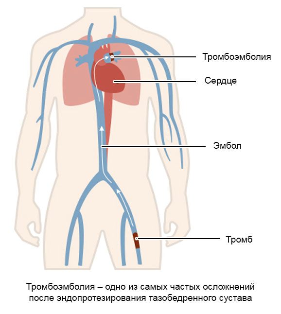 тромбоэмболия