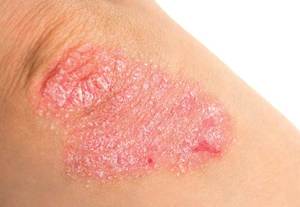 Отличие псориаза от других кожных заболеваний