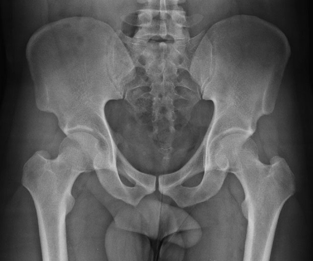 нормальная рентгенограмма таза
