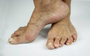 Пальцы ног, поражённые ревматоидным артритом