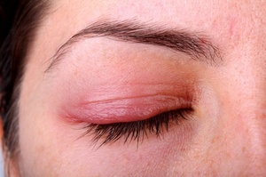 Аллергия на глазах: как лечить 