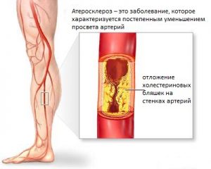Боль в ногах - самый частый симптом недуга 