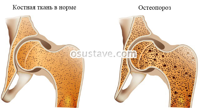 нормальная плотность костной ткани и остеопороз