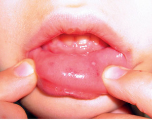 Вирусная пузырчатка: сыпь во рту