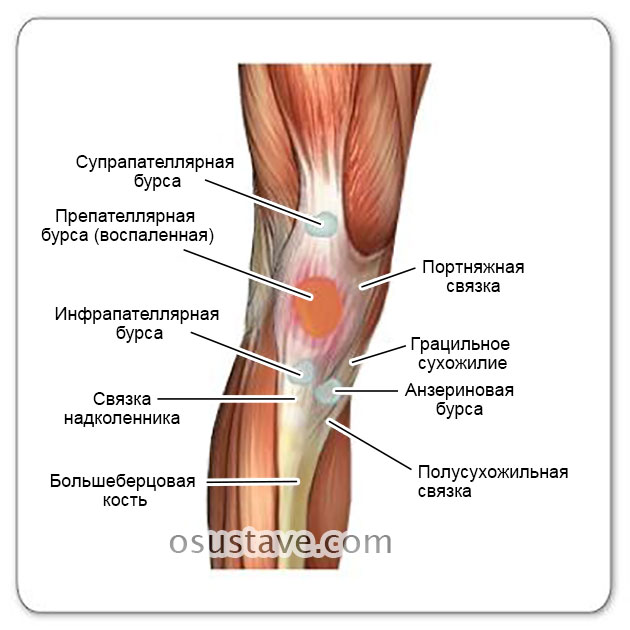 препателлярный бурсит и другие бурсы коленного сустава