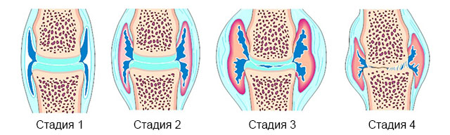 4 стадии артрита сустава