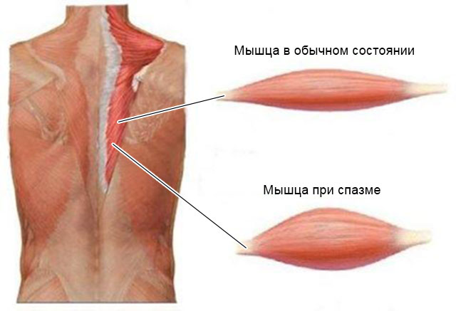 мышца при спазме