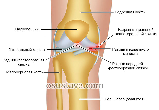 разрывы связок и менисков коленного сустава