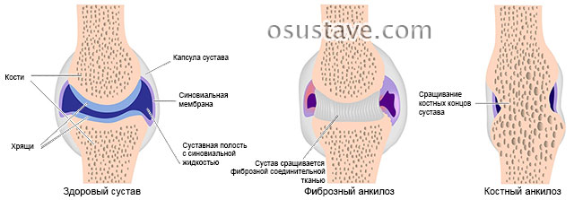 фиброзный и костный анкилоз