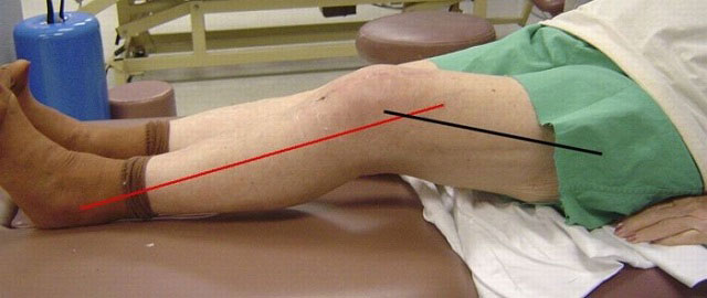 контрактура коленного сустава левой ноги