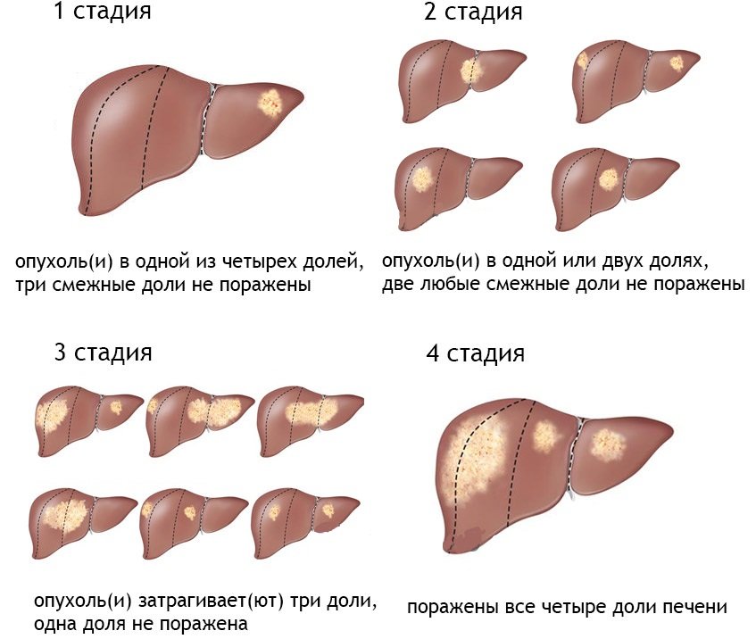 Диагностика цирроза печени на разных стадиях