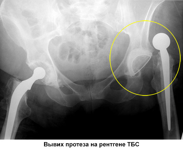 вывих протеза ТБС на рентгене