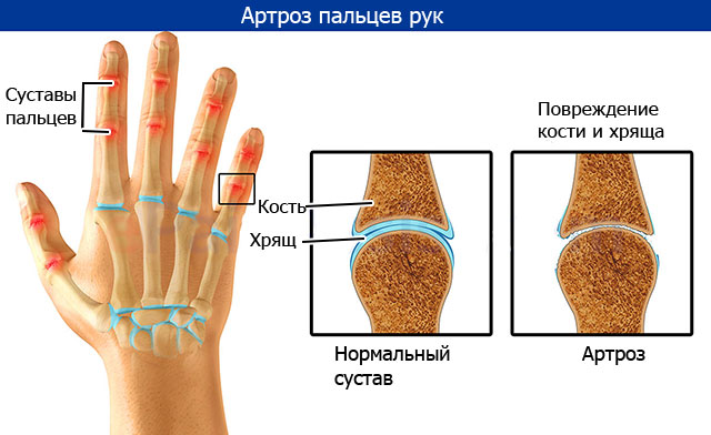 артроз пальцев рук