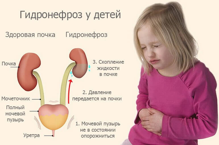 Гидронефроз почек у детей