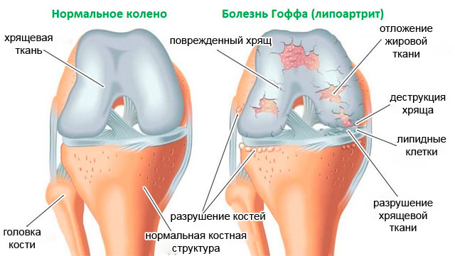 сравнительная характеристика строения колена в норме и при болезни Гоффа