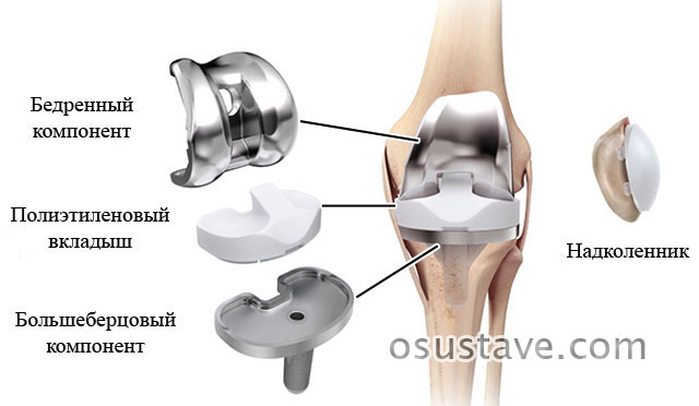 составные части имплантата для полного эндопротезирования коленного сустава