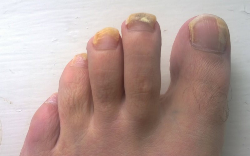 Как псориатический артрит влияет на ногти?