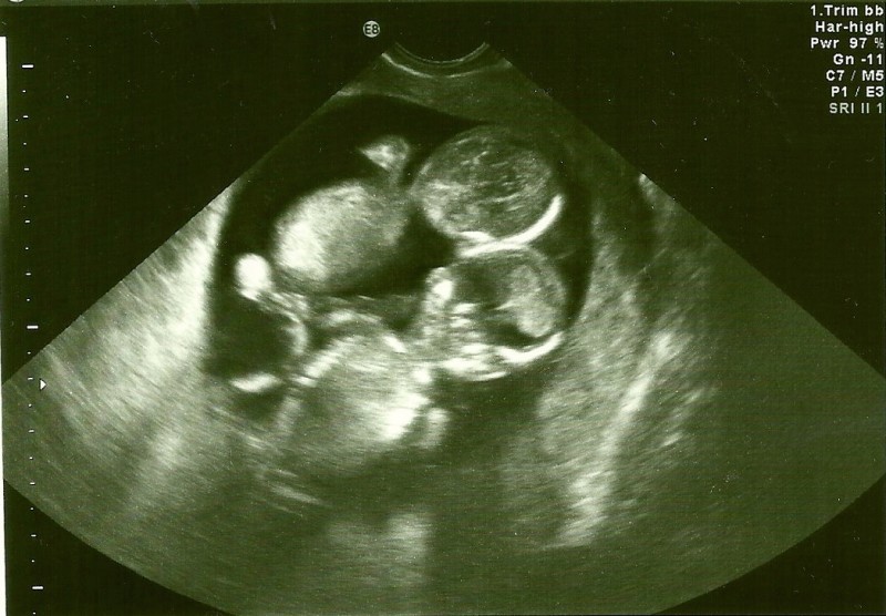 28 недель двойней. УЗИ двухплодной беременности. УЗИ 10 недель многоплодной беременности. Снимок УЗИ беременности двойней. УЗИ двойняшек на 13 неделе беременности.