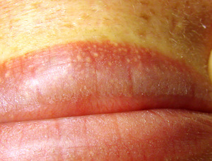 Белое пятно внутри губы