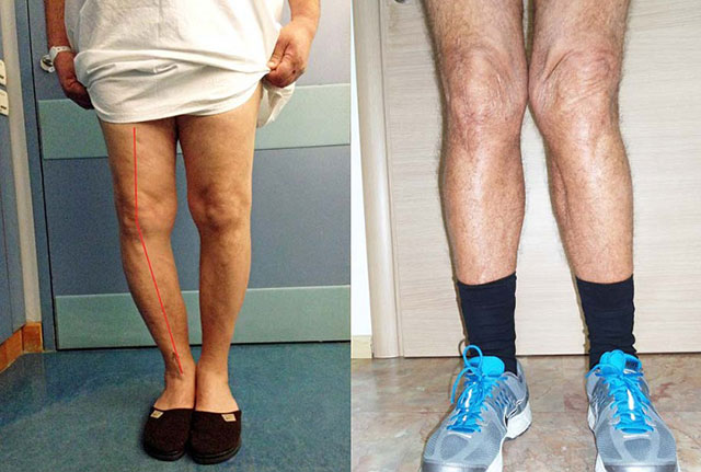 поражение коленей остеоартрозом