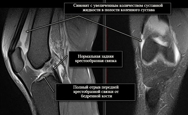 разрыв передней крестообразной связки, синовит коленного сустава на МРТ