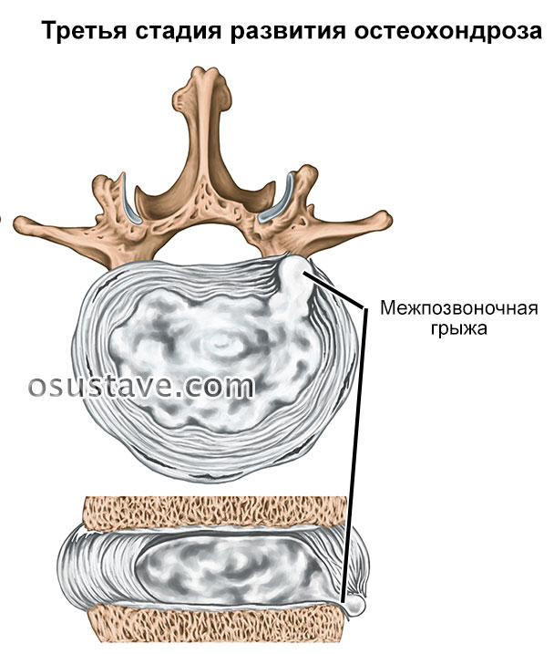 третья стадия остеохондроза