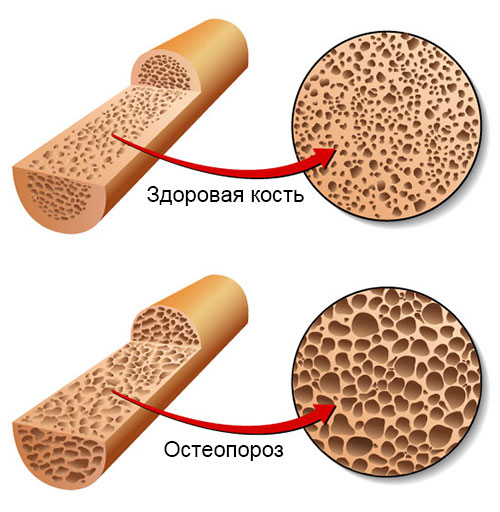 кость, пораженная остеопорозом