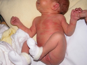 Детская вирусная пузырчатка у младенца