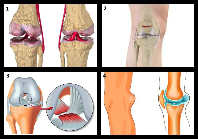 патологии коленного сустава